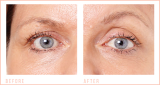 Before & After CACI Eye Revive