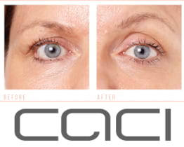 CACI Ultra Non Surgical Facial